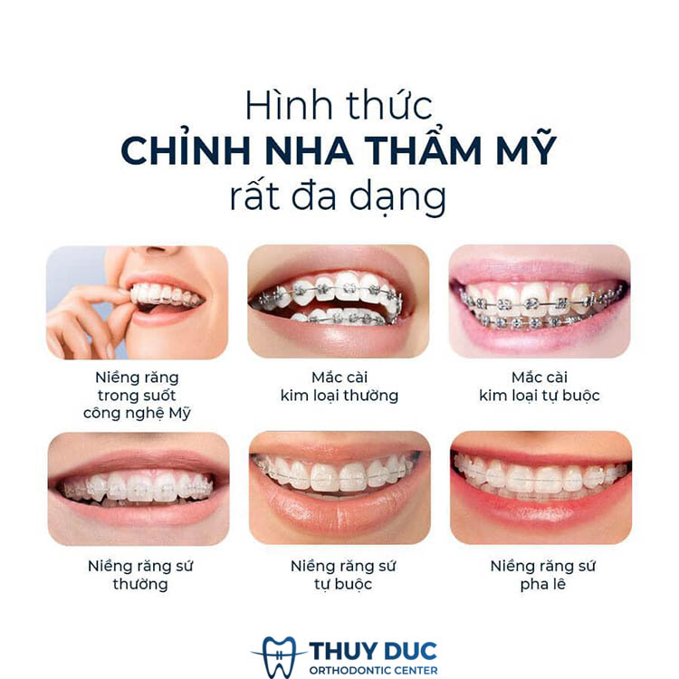 Địa chỉ niềng răng an toàn, chất lượng tại Hà Nội 3