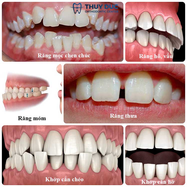 Những trường hợp nào có thể niềng răng khi đang cho con bú? 1