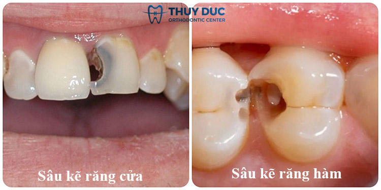Sâu kẽ răng thường nằm ở vị trí nào? 1 Sâu kẽ răng thường nằm ở vị trí nào? 1