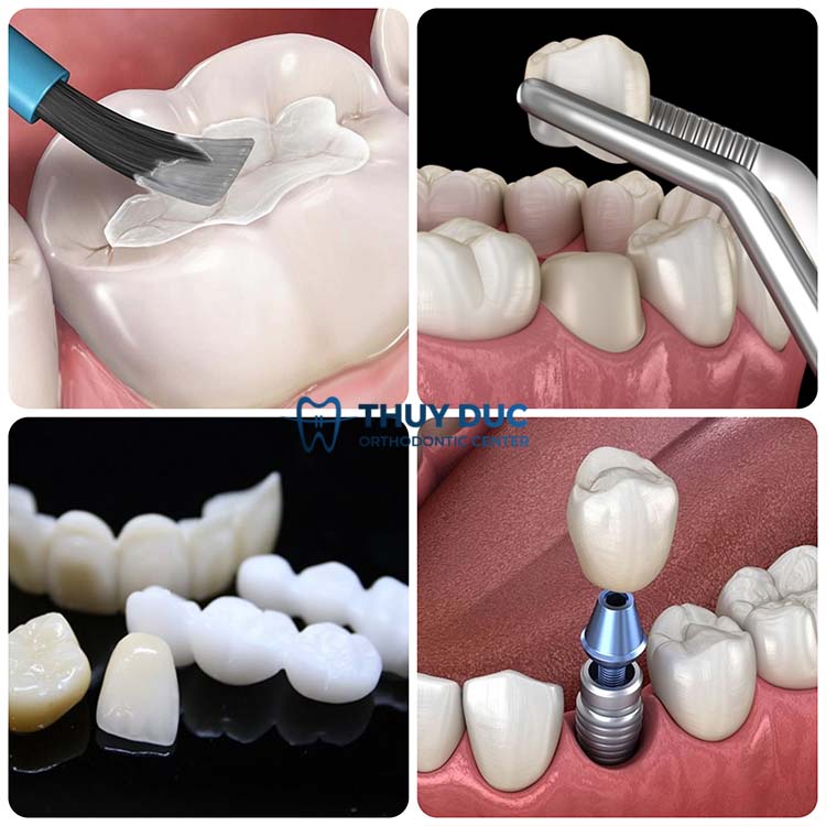 Cách giảm ê buốt sau khi mài răng tại nha khoa 1 Cách giảm ê buốt sau khi mài răng tại nha khoa 1