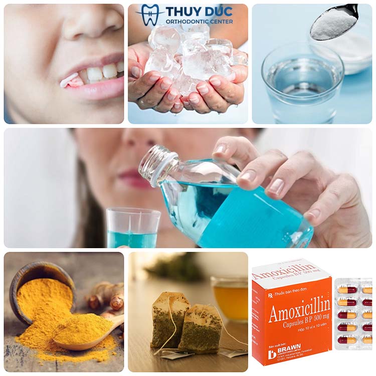 Xử lý thế nào khi chảy máu chân răng? 1 Xử lý thế nào khi chảy máu chân răng? 1