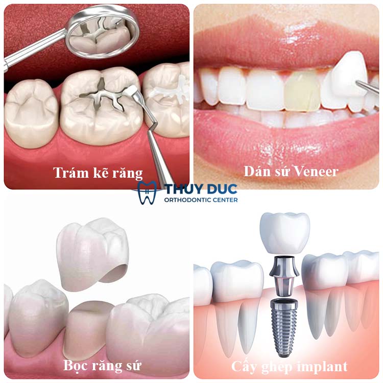 Cách trị sâu kẽ răng hiệu quả nhất tại nha khoa 1 Cách trị sâu kẽ răng hiệu quả nhất tại nha khoa 1