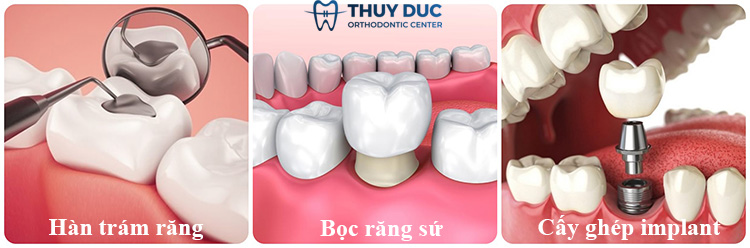 Điều trị sâu răng tại nha khoa 1 Điều trị sâu răng tại nha khoa 1