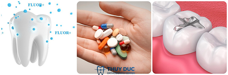 Chữa răng sâu nhẹ tại nha khoa 1 Chữa răng sâu nhẹ tại nha khoa 1