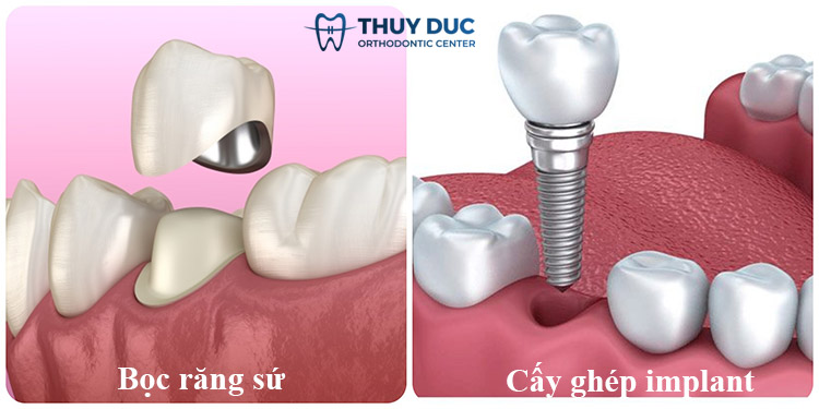 Cách trị răng vĩnh viễn bị sâu với trường hợp nặng 1 Cách trị răng vĩnh viễn bị sâu với trường hợp nặng 1