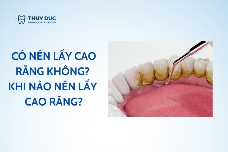Có nên lấy cao răng không? 1