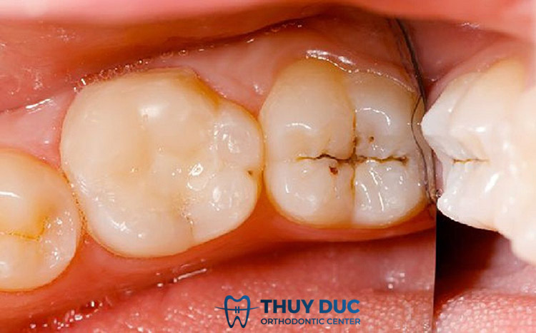 Dấu hiệu nhận biết răng vĩnh viễn bị sâu 1 Dấu hiệu nhận biết răng vĩnh viễn bị sâu 1
