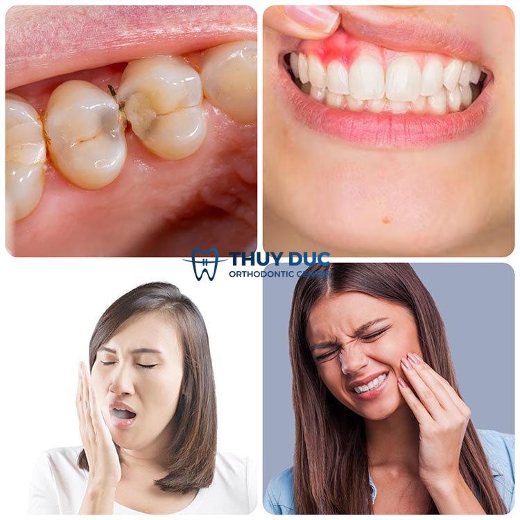 Các dấu hiệu nhận biết sâu kẽ răng chi tiết nhất 1 Các dấu hiệu nhận biết sâu kẽ răng chi tiết nhất 1