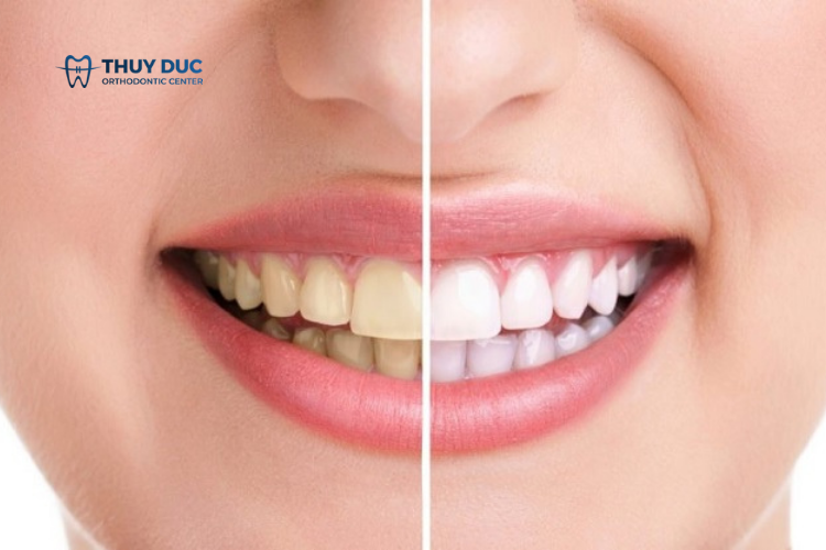 Răng vàng có chữa được không? 1