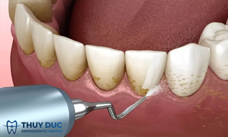 Kỹ thuật áp dụng 1