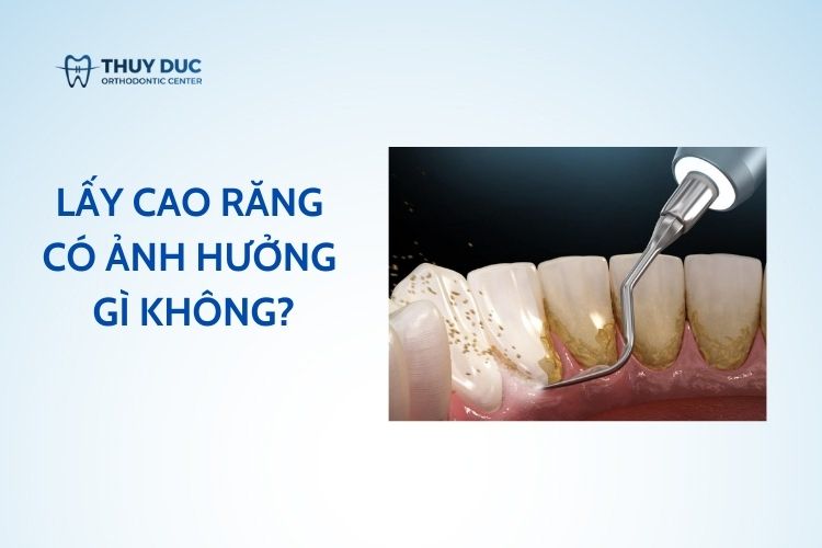 Lấy cao răng có ảnh hưởng gì không? 1