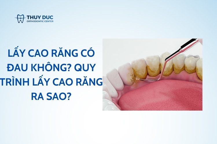 Lấy cao răng có đau không? Quy trình lấy cao răng ra sao? 1