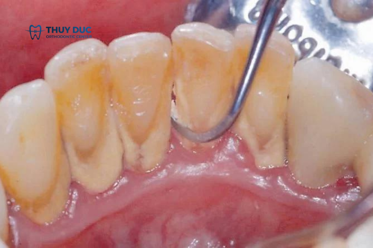 Lấy cao răng có lợi ích gì? 1 Lấy cao răng có lợi ích gì? 1