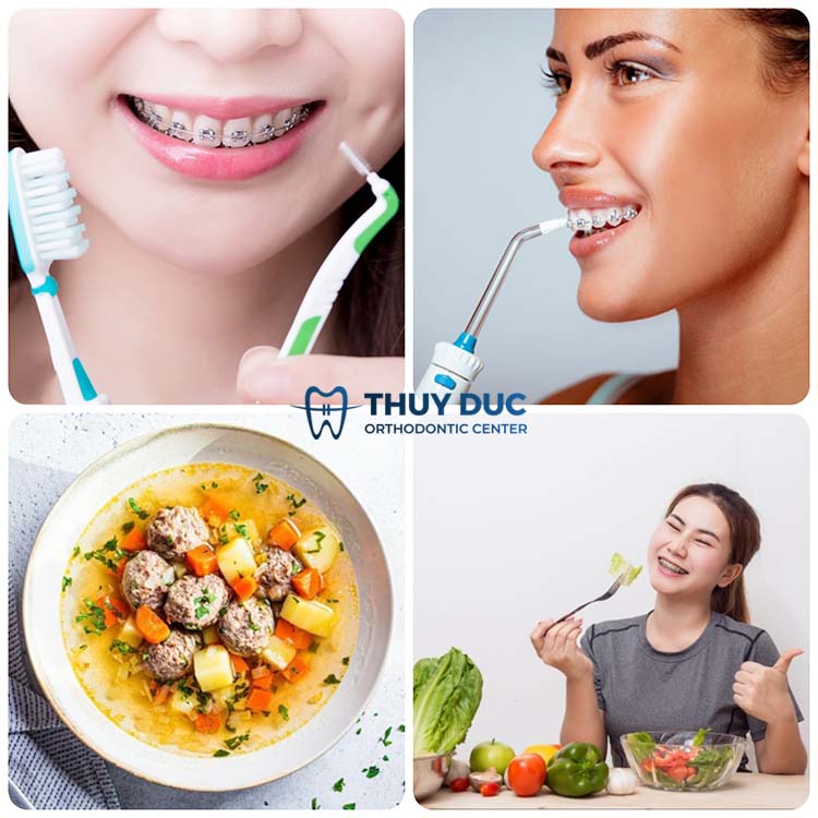 Những lưu ý khi niềng răng với người đang cho con bú 1