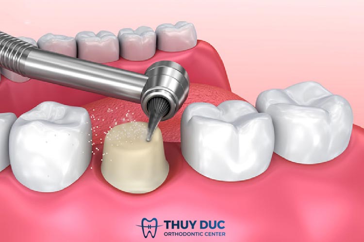 Mài cùi răng là gì? 1 Mài cùi răng là gì? 1