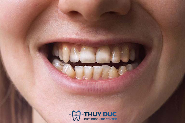 Đánh giá các yếu tố dễ gây sâu răng nhất 1 Đánh giá các yếu tố dễ gây sâu răng nhất 1