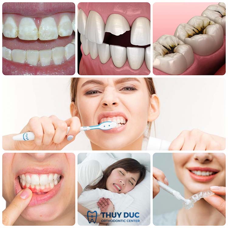 Nguyên nhân làm cho ăn đồ ngọt bị buốt răng 1