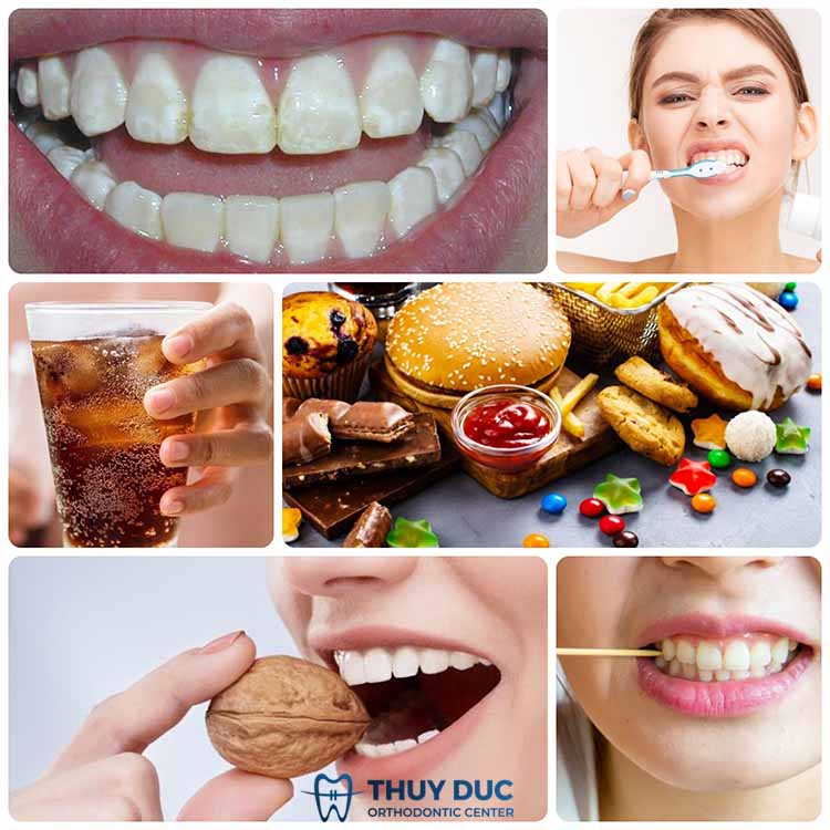 Tìm hiểu nguyên nhân gây tình trạng sâu kẽ răng 1 Tìm hiểu nguyên nhân gây tình trạng sâu kẽ răng 1