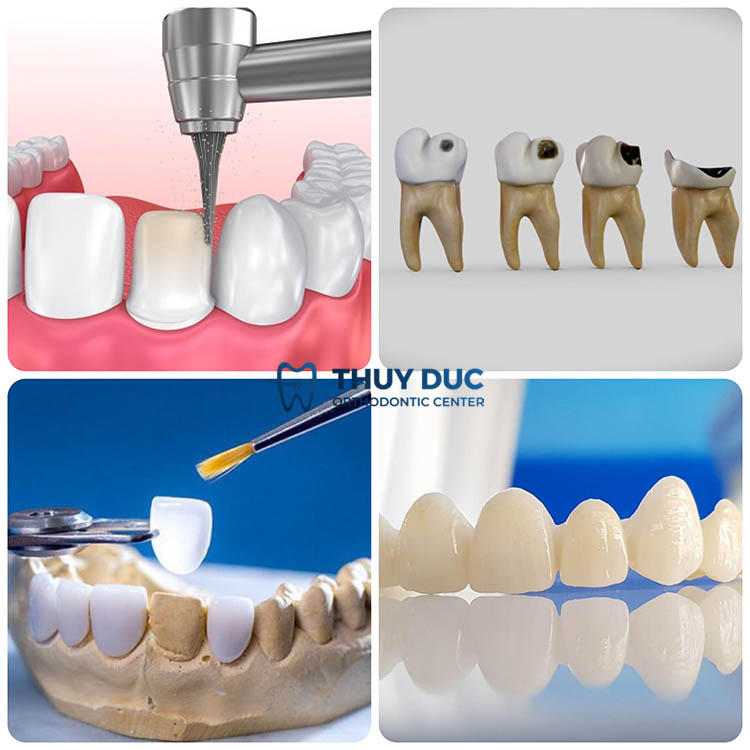 Nguyên nhân răng ê buốt từ bác sĩ và nha khoa 1 Nguyên nhân răng ê buốt từ bác sĩ và nha khoa 1