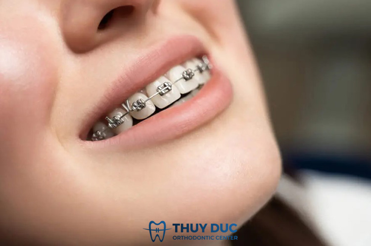Niềng răng mắc cài kim loại 1