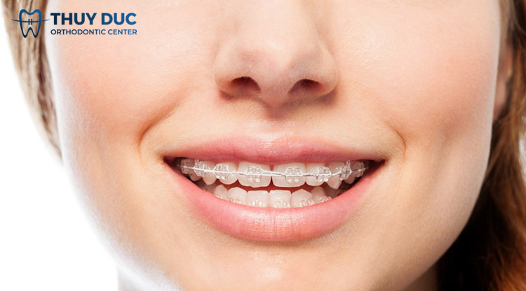 Niềng răng mắc cài sứ 1