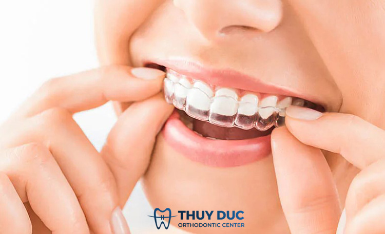Niềng răng trong suốt Invisalign 1