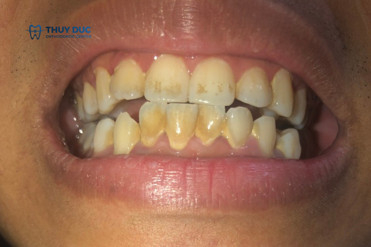 Răng ố vàng là bệnh gì? Có chữa khỏi được không? 1