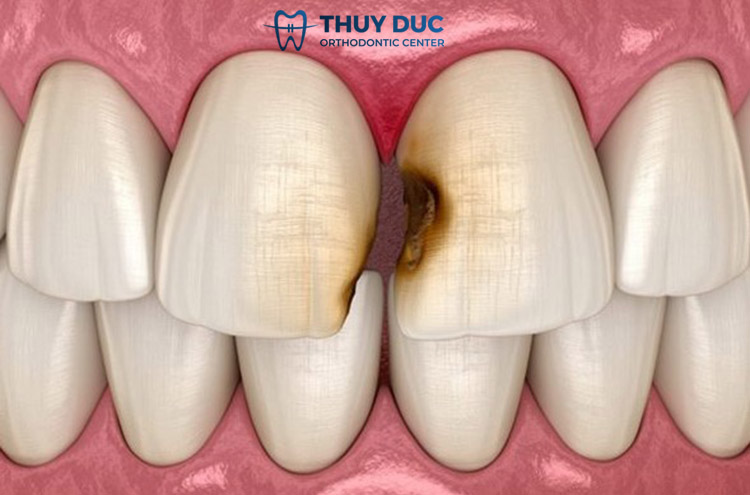 Sâu kẽ răng là gì? 1 Sâu kẽ răng là gì? 1