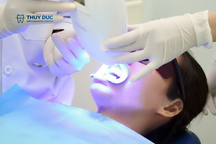 Trị răng ố vàng tại nha khoa 1