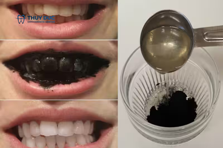 Trị răng ố vàng tại nhà 1