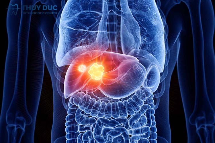 Ung thư gan, xơ gan 1 Ung thư gan, xơ gan 1