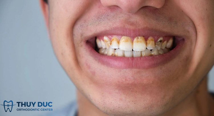 Vì sao bị sâu răng? 1 Vì sao bị sâu răng? 1