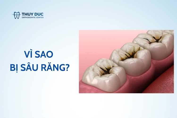 Vì sao bị sâu răng- Giải đáp trực tiếp của chuyên gia - Bác sĩ Đức AAO