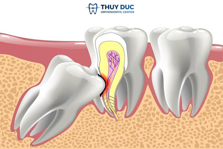 Vì sao răng khôn mọc lệch làm cho răng số 7 bị sâu? 1 Vì sao răng khôn mọc lệch làm cho răng số 7 bị sâu? 1