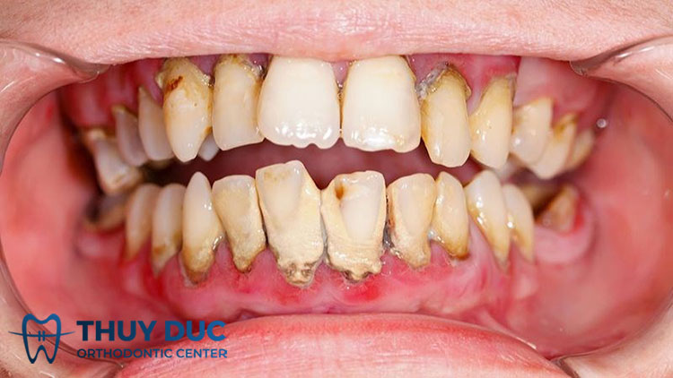 Nguy cơ viêm nhiễm và bệnh nha chu 1