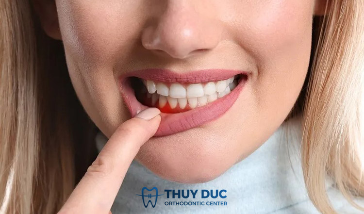 Bệnh viêm nướu 1 Bệnh viêm nướu 1