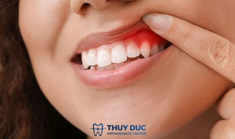 Tìm hiểu nguyên nhân gây chảy máu chân răng thường xuyên 1 Tìm hiểu nguyên nhân gây chảy máu chân răng thường xuyên 1