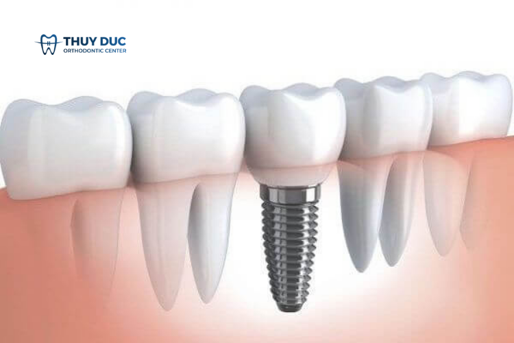 Bệnh tiểu đường có trồng implant được không? 1