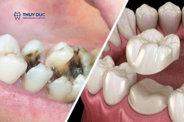 Điều trị sâu răng tại nha khoa 3 Điều trị sâu răng tại nha khoa 3