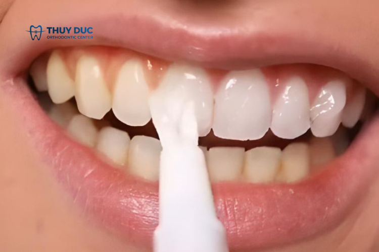 Bút tẩy trắng răng là gì? 1 Bút tẩy trắng răng là gì? 1