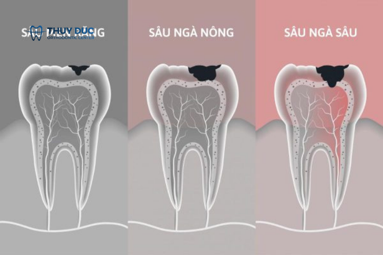Mức độ sâu của răng 1 Mức độ sâu của răng 1