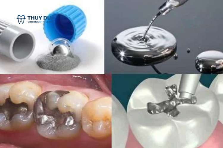 Chi phí hàn răng sâu giá bao nhiêu tiền? 1 Chi phí hàn răng sâu giá bao nhiêu tiền? 1