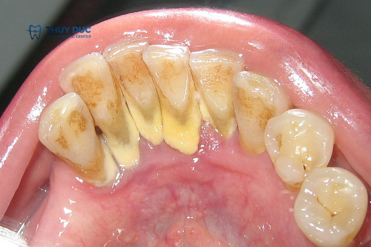 Cao răng là gì? 1