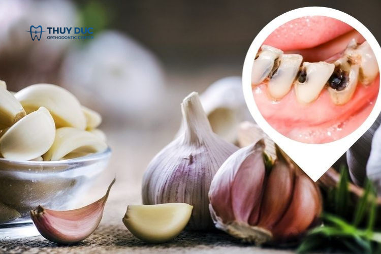 Chữa sâu răng bằng tỏi 1 Chữa sâu răng bằng tỏi 1