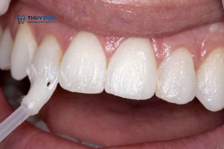 Điều trị sâu răng tại nha khoa 1 Điều trị sâu răng tại nha khoa 1