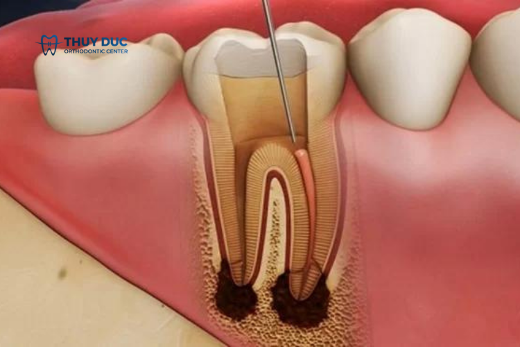Điều trị sâu răng tại nha khoa 4 Điều trị sâu răng tại nha khoa 4