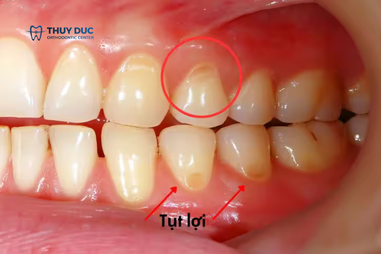 Tụt lợi là gì? Có nguy hiểm không? 1