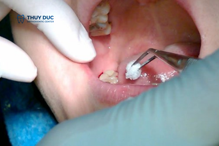 Có màng trắng sau khi nhổ răng có sao không? 1 Có màng trắng sau khi nhổ răng có sao không? 1