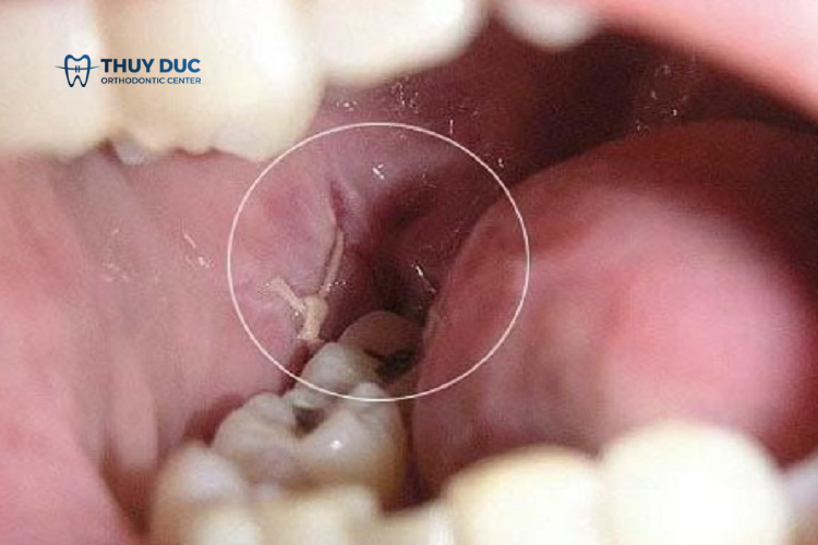 Màng trắng sau khi nhổ răng là gì? Vì sao có? 1 Màng trắng sau khi nhổ răng là gì? Vì sao có? 1