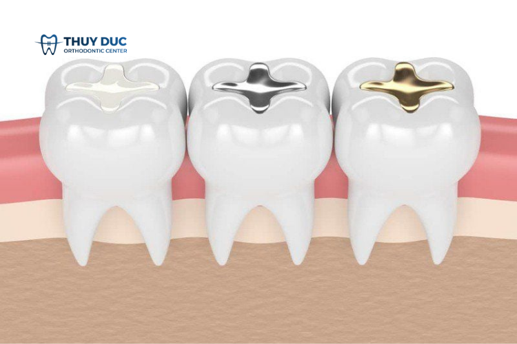 Loại vật liệu trám 1 Loại vật liệu trám 1